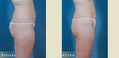 Female Liposuction Before & After Gallery - Patient 121025 - Image 5