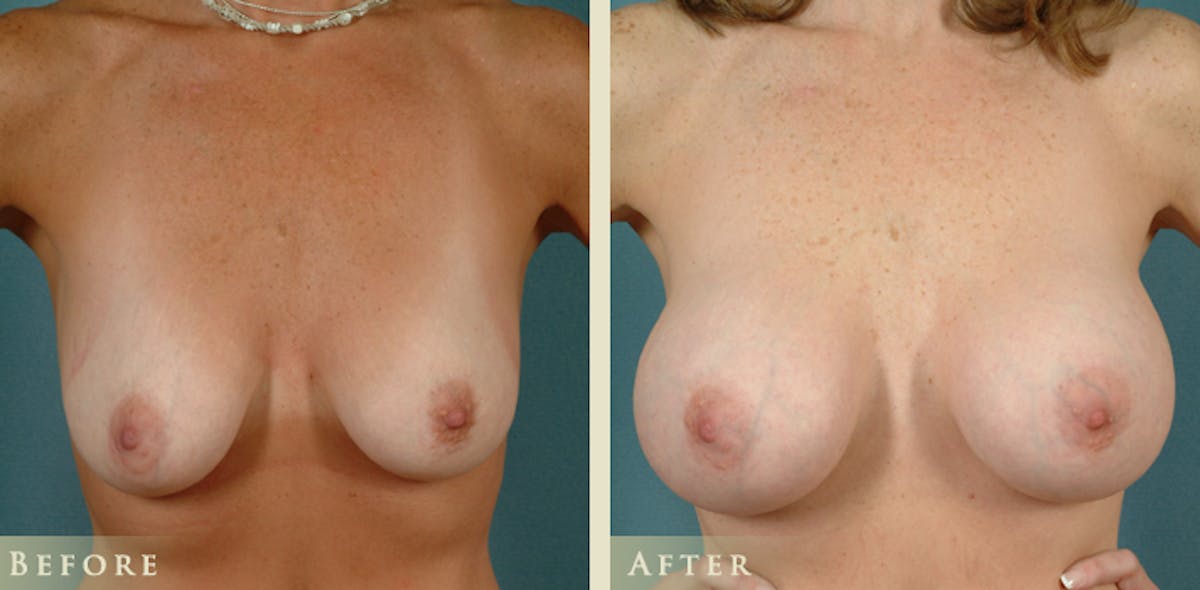 Breast Augmentation with Saline Implants Before & After Gallery - Patient 263971 - Image 1