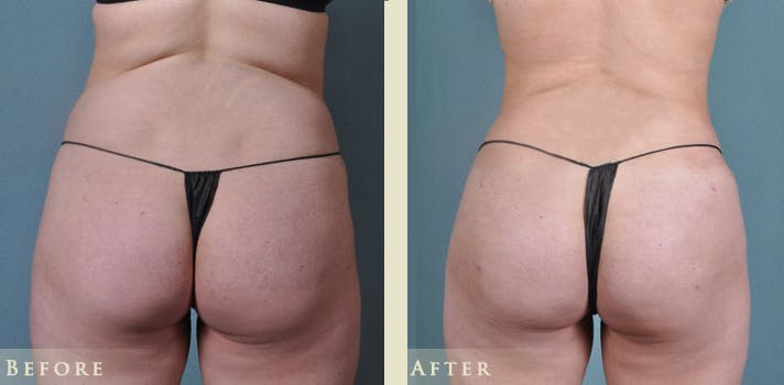 Brazilian Butt Lift Before & After Gallery - Patient 337563 - Image 1