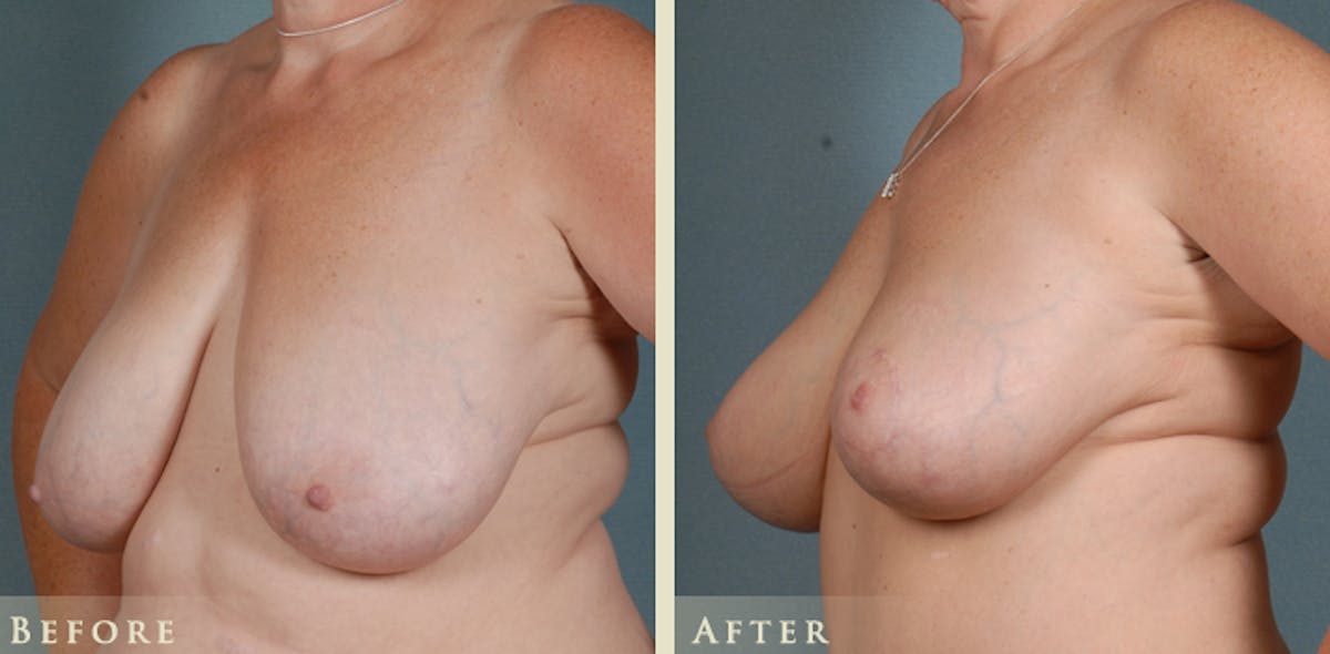 Breast Lift Before & After Gallery - Patient 370745 - Image 2