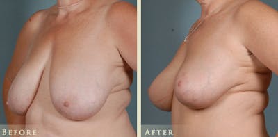 Breast Lift Before & After Gallery - Patient 370745 - Image 2