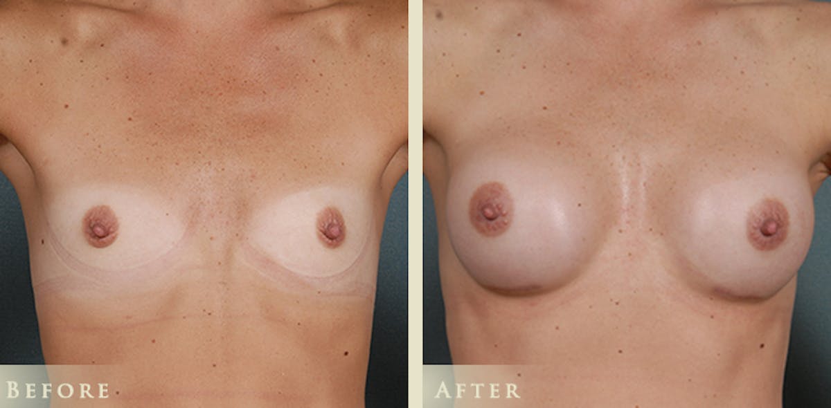 Breast Augmentation with Silicone Implants Before & After Gallery - Patient 407219 - Image 1