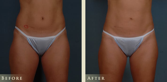 Female Liposuction Before & After Gallery - Patient 387055 - Image 1