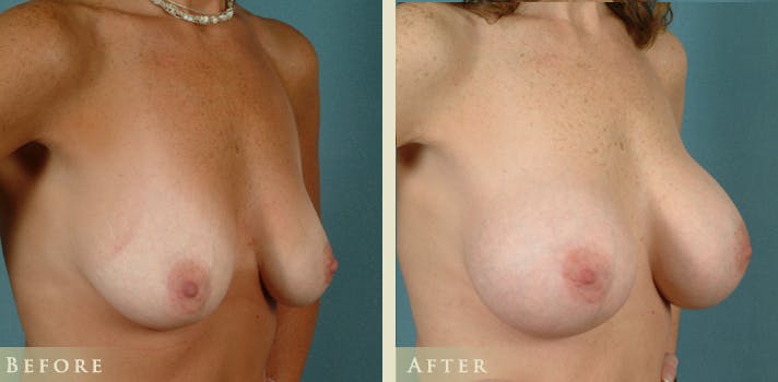 Breast Augmentation Before & After Gallery - Patient 850489 - Image 2