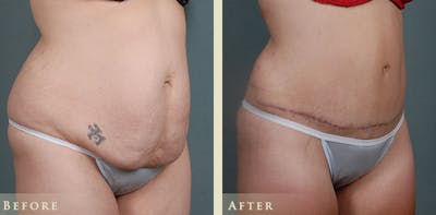 Tummy Tuck Before & After Gallery - Patient 185889 - Image 2