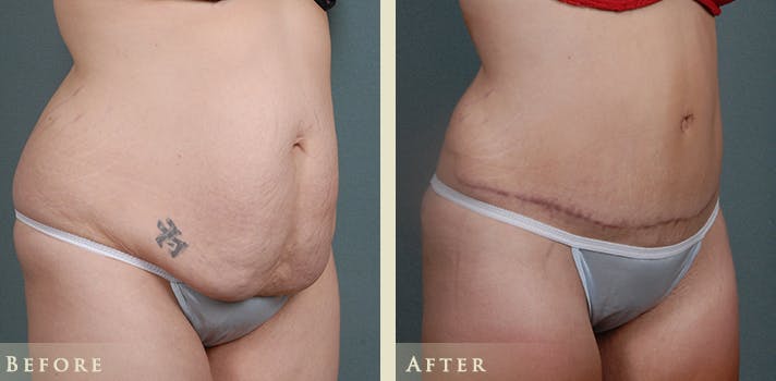 Tummy Tuck Before & After Gallery - Patient 185889 - Image 2