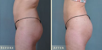 Brazilian Butt Lift Before & After Gallery - Patient 337563 - Image 2