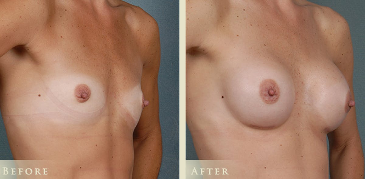 Breast Augmentation with Silicone Implants Before & After Gallery - Patient 407219 - Image 2