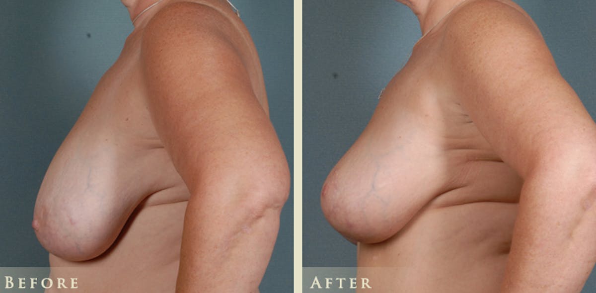 Breast Lift Before & After Gallery - Patient 370745 - Image 3