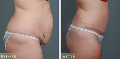Tummy Tuck Before & After Gallery - Patient 185889 - Image 3