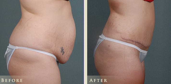 Tummy Tuck Before & After Gallery - Patient 185889 - Image 3