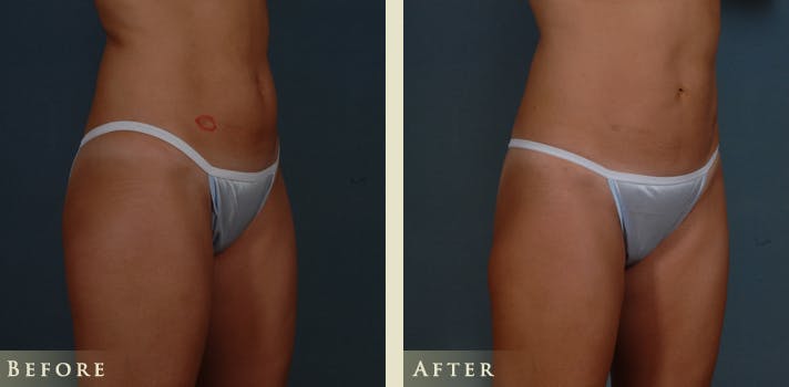 Female Liposuction Before & After Gallery - Patient 387055 - Image 2
