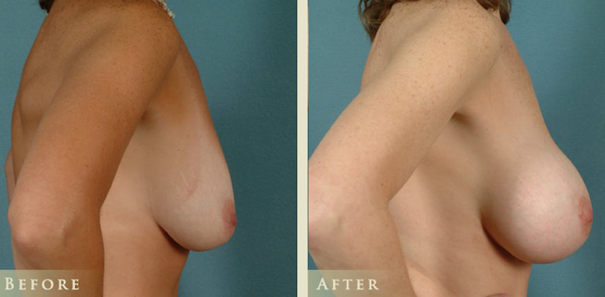 Breast Augmentation with Saline Implants Before & After Gallery - Patient 263971 - Image 3