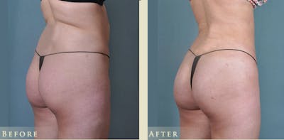 Brazilian Butt Lift Before & After Gallery - Patient 337563 - Image 3