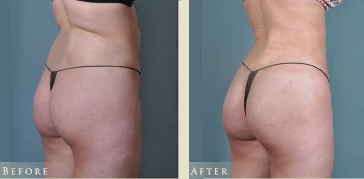 Brazilian Butt Lift Before & After Gallery - Patient 337563 - Image 3