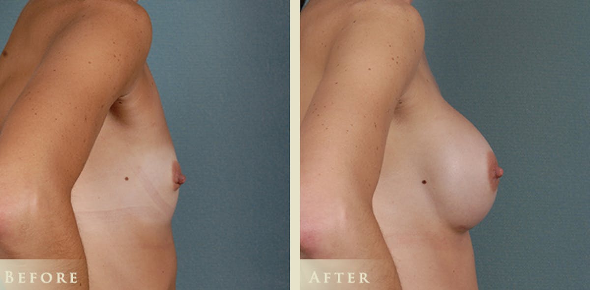Breast Augmentation with Silicone Implants Before & After Gallery - Patient 407219 - Image 3
