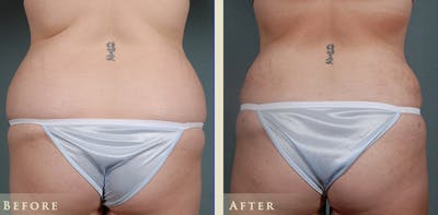 Tummy Tuck Before & After Gallery - Patient 185889 - Image 4