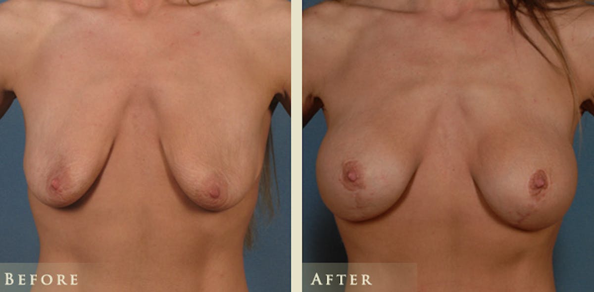 Breast Augmentation and Lift  Before & After Gallery - Patient 282804 - Image 1