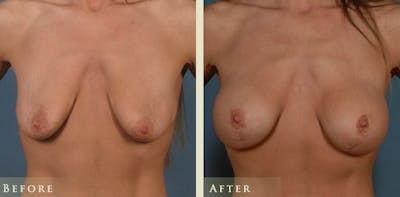 Breast Augmentation and Lift  Before & After Gallery - Patient 282804 - Image 1