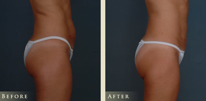 Female Liposuction Before & After Gallery - Patient 387055 - Image 3