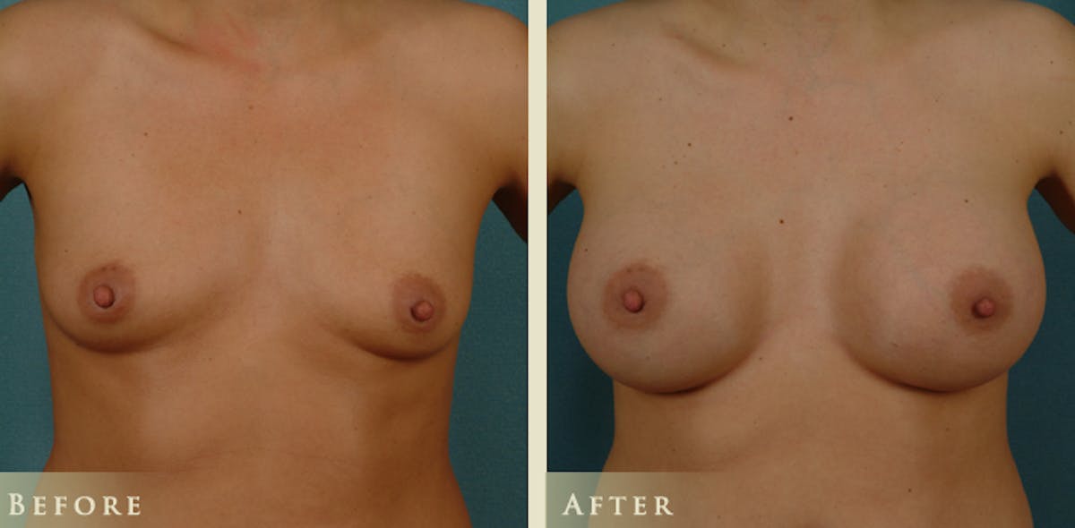 Breast Augmentation with Saline Implants Before & After Gallery - Patient 119409 - Image 1