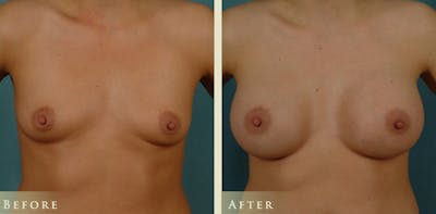 Breast Augmentation Before & After Gallery - Patient 109383 - Image 1
