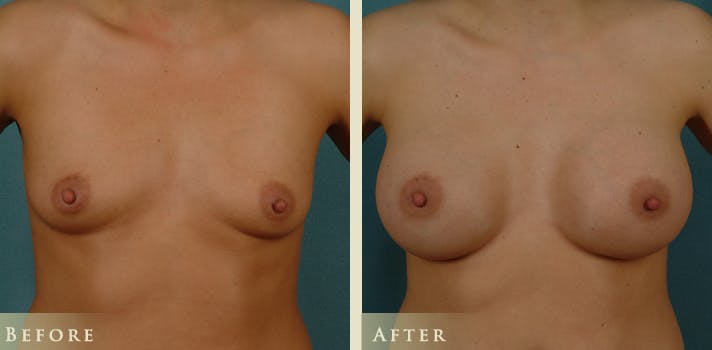 Breast Augmentation Before & After Gallery - Patient 109383 - Image 1