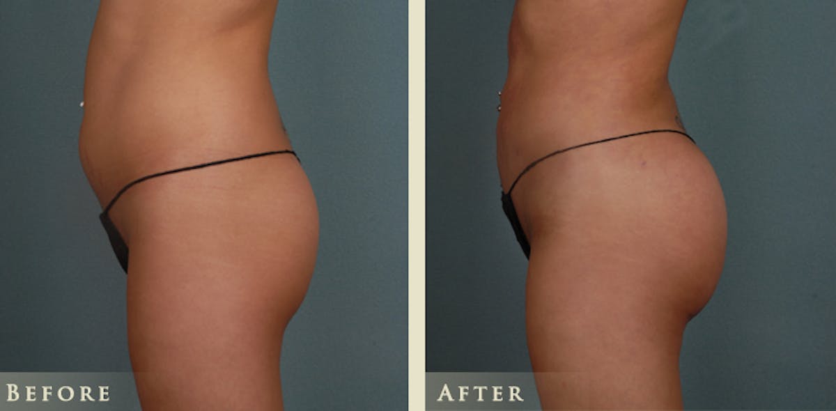 Brazilian Butt Lift Before & After Gallery - Patient 362477 - Image 1
