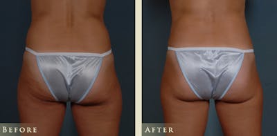 Female Liposuction Before & After Gallery - Patient 387055 - Image 4