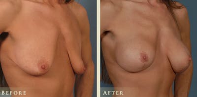 Breast Augmentation and Lift Before & After Gallery - Patient 282804 - Image 2