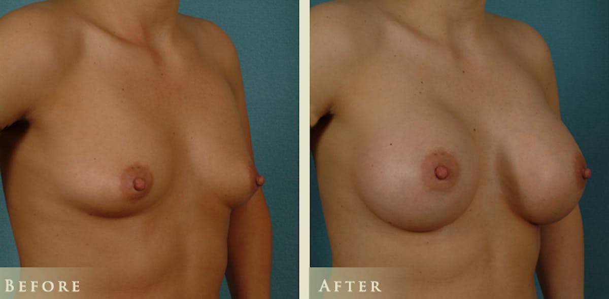 Breast Augmentation with Saline Implants Before & After Gallery - Patient 119409 - Image 2