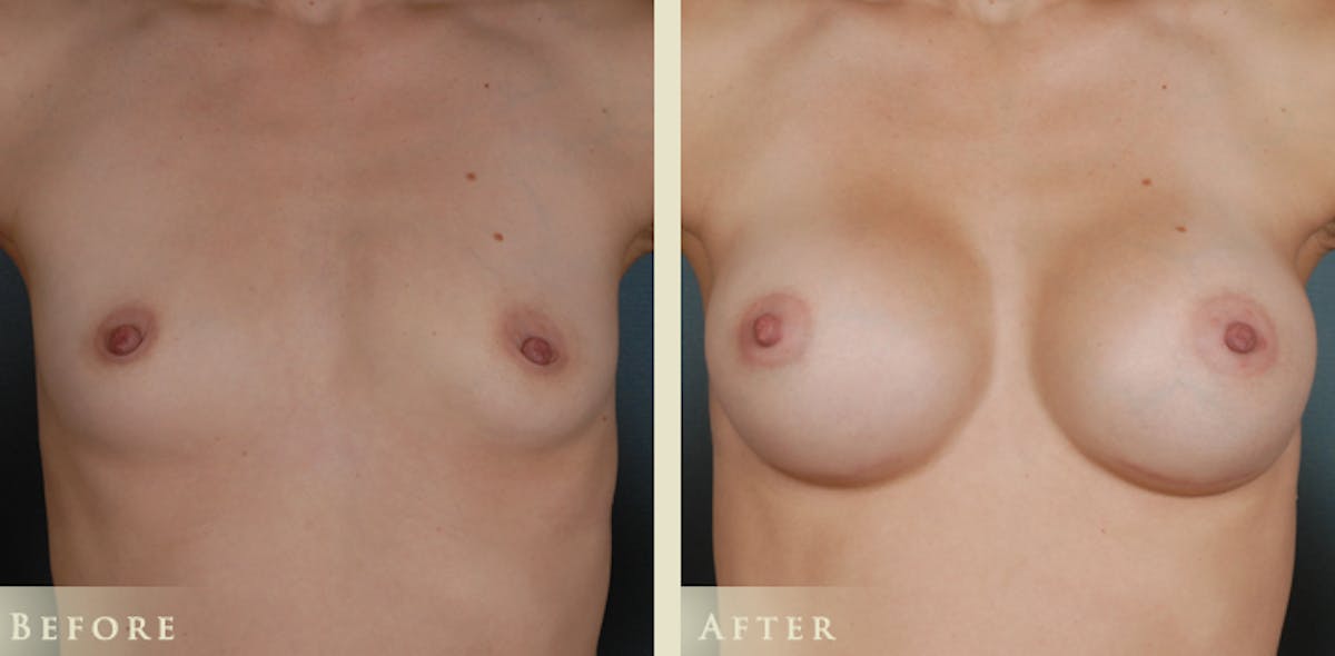 Breast Augmentation with Silicone Implants Before & After Gallery - Patient 334668 - Image 1