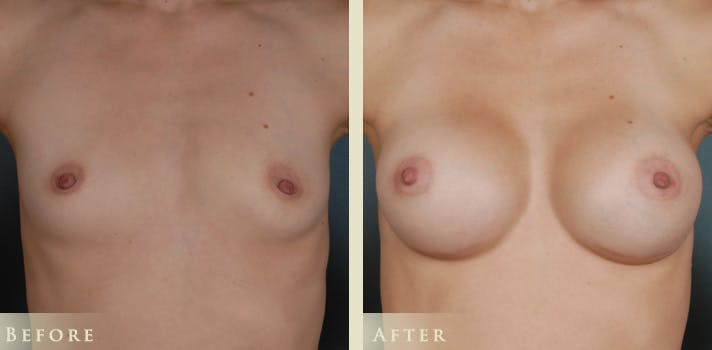 Breast Augmentation Before & After Gallery - Patient 334668 - Image 1