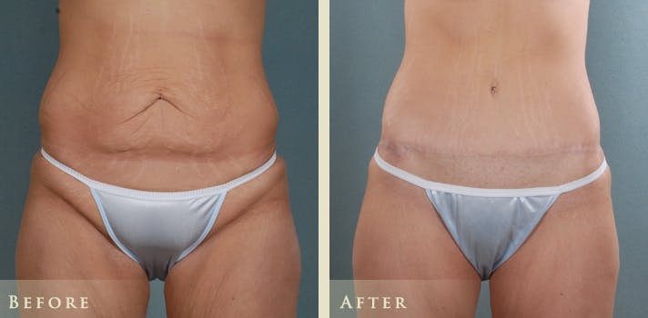 Tummy Tuck Before & After Gallery - Patient 333566 - Image 1