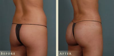 Brazilian Butt Lift Before & After Gallery - Patient 362477 - Image 2