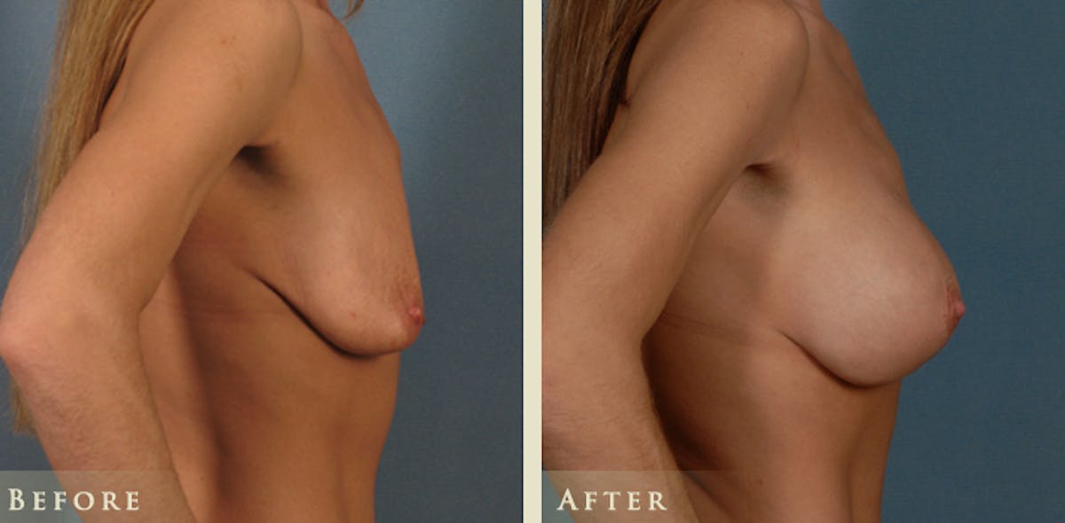 Breast Augmentation and Lift  Before & After Gallery - Patient 282804 - Image 3