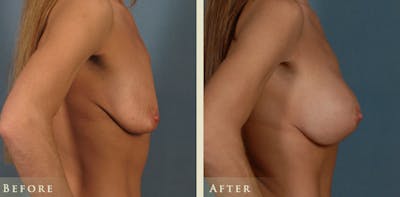 Breast Augmentation and Lift Before & After Gallery - Patient 282804 - Image 3