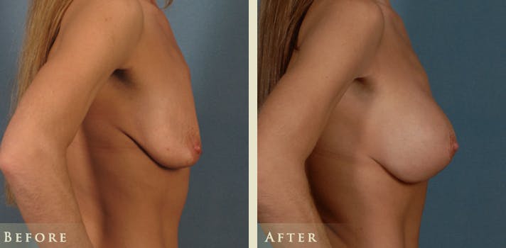 Breast Augmentation and Lift  Before & After Gallery - Patient 282804 - Image 3