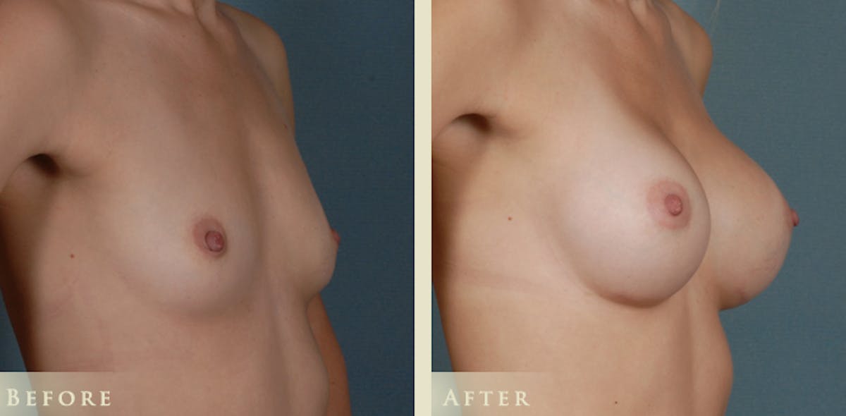 Breast Augmentation with Silicone Implants Before & After Gallery - Patient 334668 - Image 2