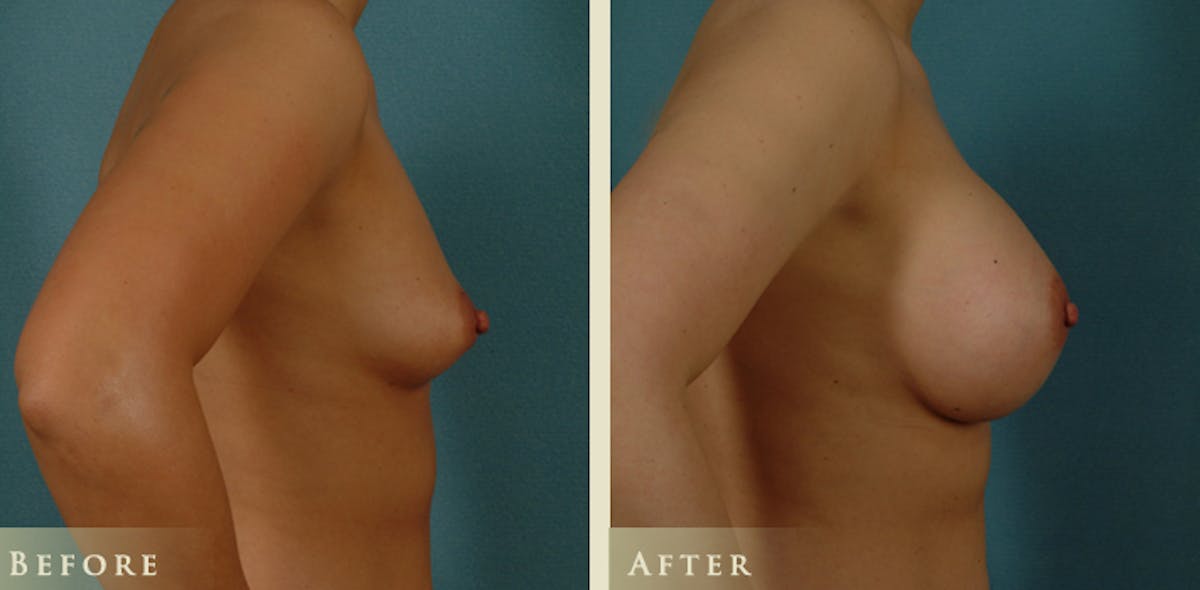 Breast Augmentation with Saline Implants Before & After Gallery - Patient 119409 - Image 3