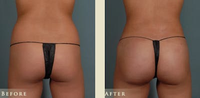 Brazilian Butt Lift Before & After Gallery - Patient 362477 - Image 3