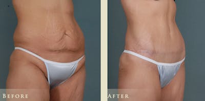 Tummy Tuck Before & After Gallery - Patient 333566 - Image 2