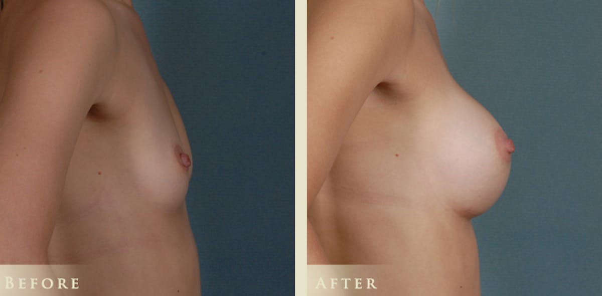 Breast Augmentation with Silicone Implants Before & After Gallery - Patient 334668 - Image 3