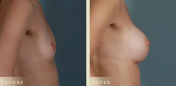 Breast Augmentation Before & After Gallery - Patient 334668 - Image 3