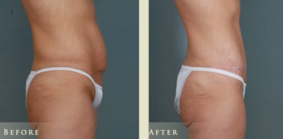 Tummy Tuck Before & After Gallery - Patient 333566 - Image 3