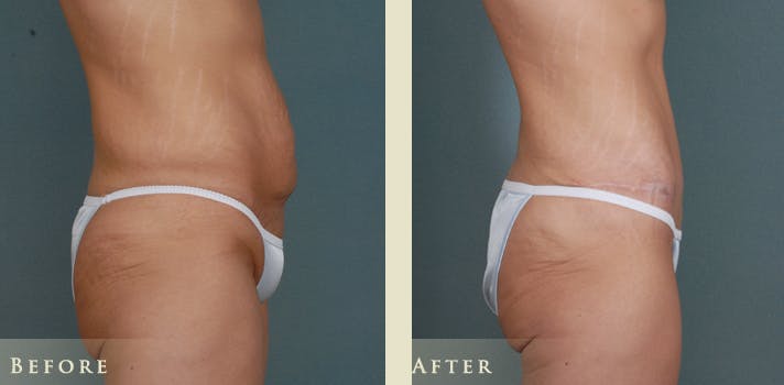 Tummy Tuck Before & After Gallery - Patient 333566 - Image 3