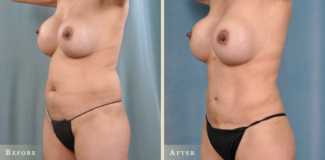 Female Liposuction Before & After Gallery - Patient 159448 - Image 2