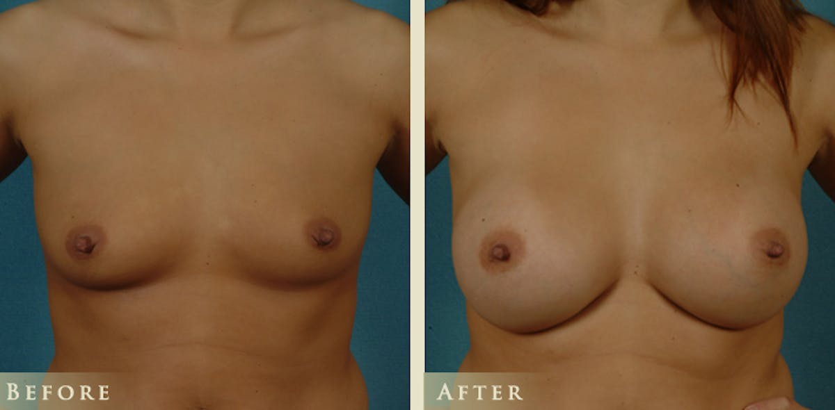 Breast Augmentation with Saline Implants Before & After Gallery - Patient 117143 - Image 1