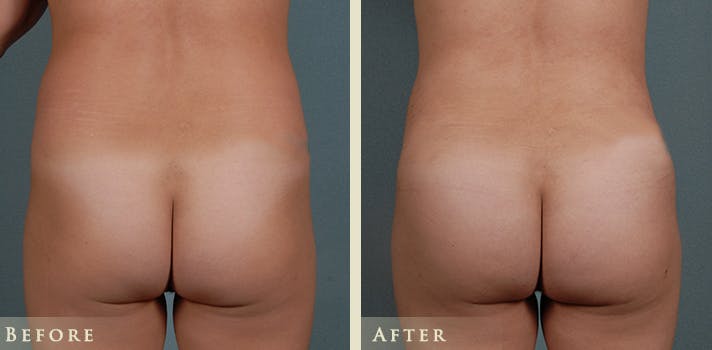 Brazilian Butt Lift Before & After Gallery - Patient 414358 - Image 1