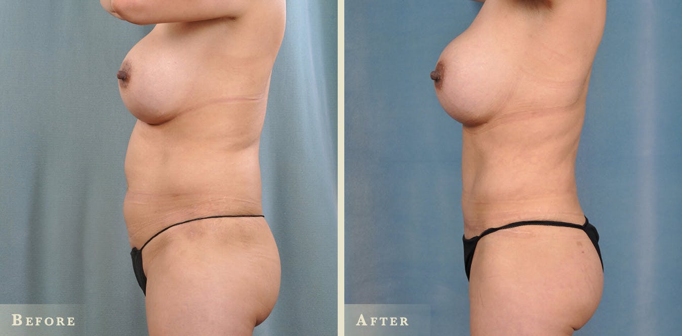 Female Liposuction Before & After Gallery - Patient 159448 - Image 3